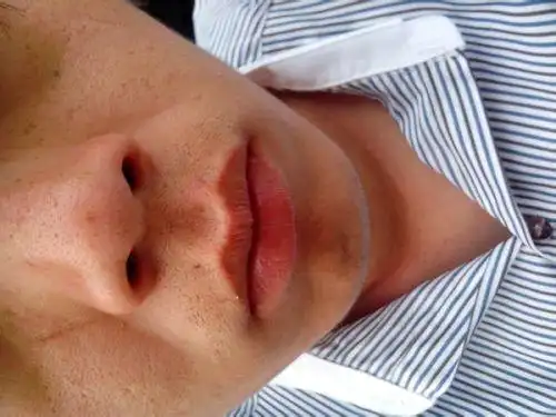 男生,毛孔粗大,有图片,谁能帮帮我