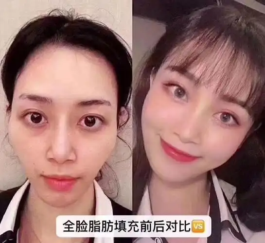 自体脂肪全脸填充一般多久适合第二次填充?