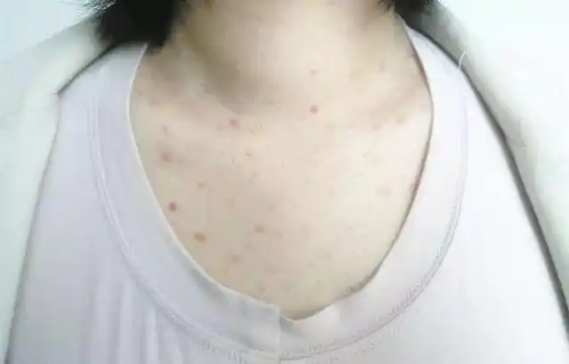 好物菌的一位同事得了毛囊炎, 去医院看医生说就是因为睡眠