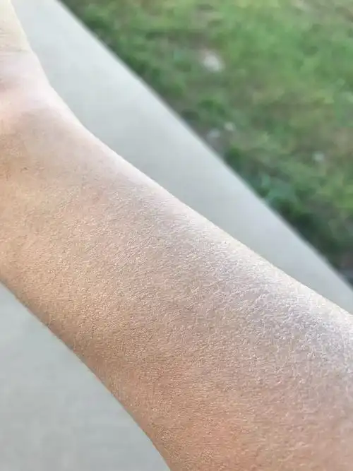 身上出现这种干皮是怎么回事呢胳膊腿还有手前胸也有还