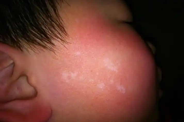 儿童脸上白斑的图片_有来医生