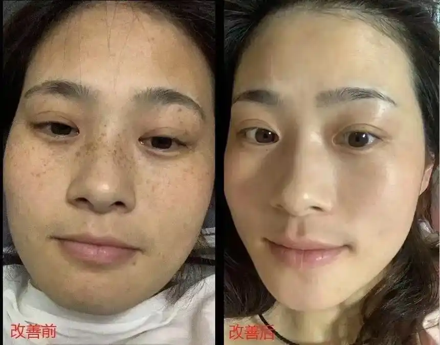 问题性皮肤管理 #美白淡斑淡痘印 #提亮肤色改善暗沉 #打 - 抖音