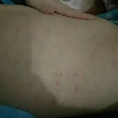 我吃了虾之后就过敏了,腹部和后背全是红点点,又痒又难受,怀孕一个月