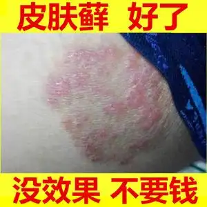 李氏百草膏大腿内侧真菌感染癣药膏股藓体股苗家皮肤癣牛皮癣药治
