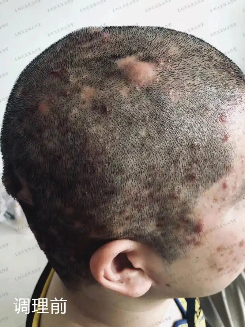患有穿掘性毛囊炎伴面部痤疮的问题(图1),头上的脓包和红疙瘩又痛又