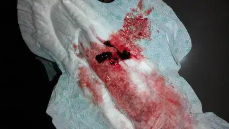 问:怀孕快两个月了…有先兆流产迹象!持续出血!