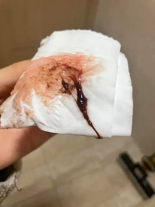 月经夹很多褐色白带是怎么回事有图慎入