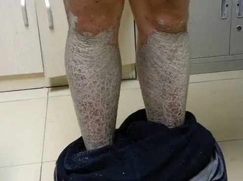 鱼鳞病的诊断要注意什么