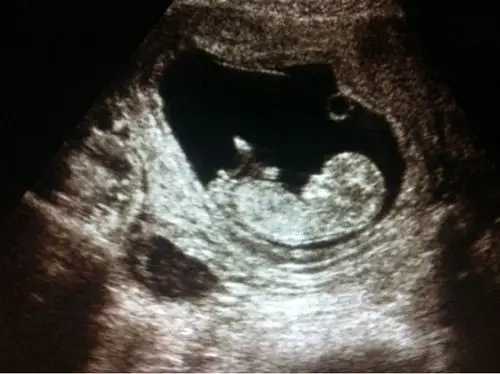 悄悄告诉你,如何从黑白彩超看胎儿性别,医生不说