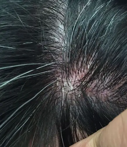 头皮大红,且蜕皮!是病吗?什么病?