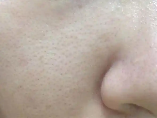 毛孔粗大——怎么有效改善毛孔粗大,收缩毛孔?