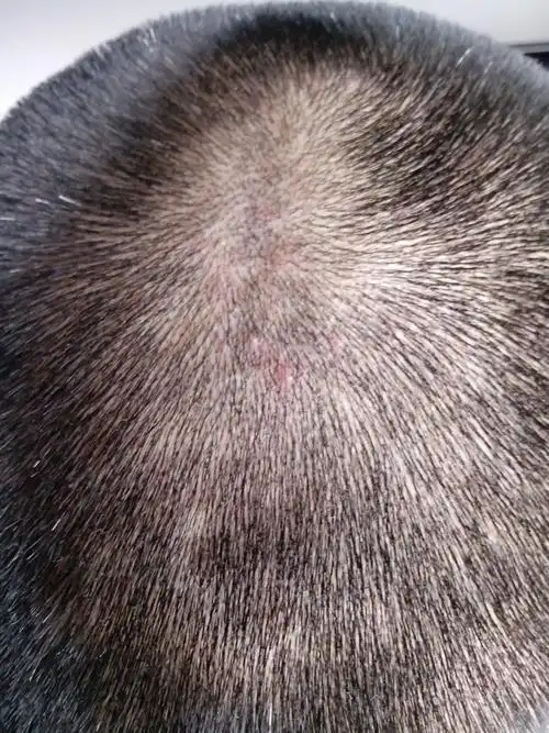 头皮上长成片的小红疙瘩 很痒 挠后很疼 破溃 痛苦不已 求大家帮助