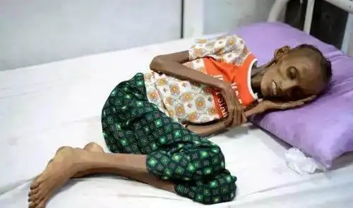 瘦如皮包骨头的十八岁女孩只因为没有吃的