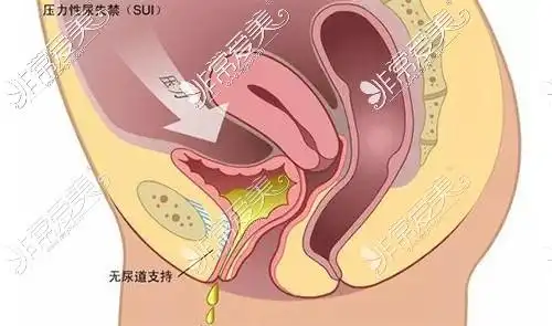 姐姐和我做过缩阴紧缩术两年的亲身经历管几年看个人差异