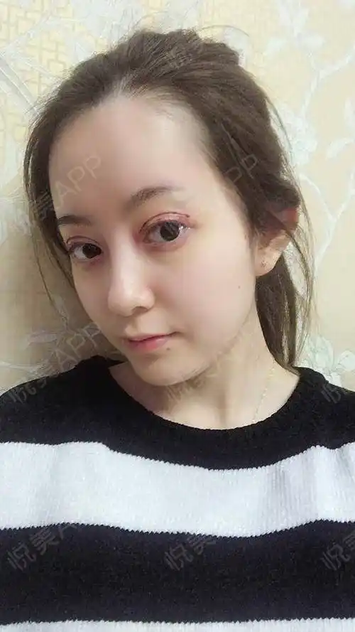 上睑下垂矫正术后15天_眼综合整形术后15天_开内眼角术后15天_全切双