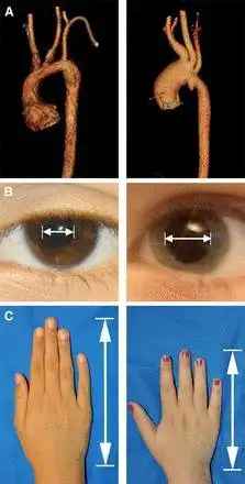 马凡综合征天才病巨人杀手