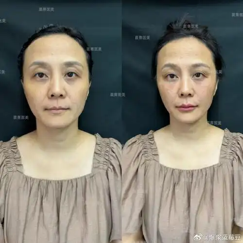 润致千人千面##我的轮廓线##润致玻尿酸##华熙生