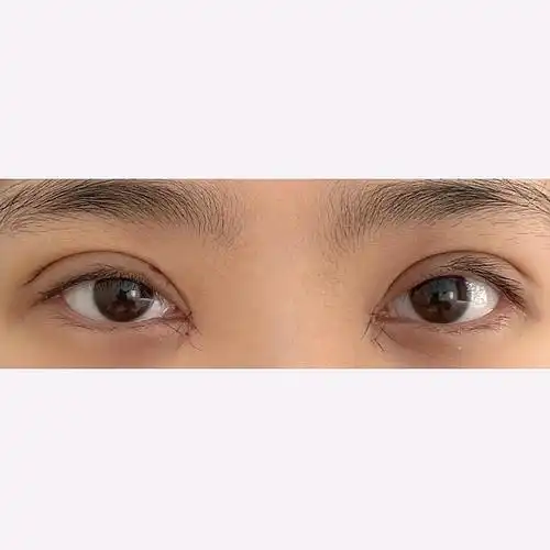 全切双眼皮内眼角提肌矫正如今看看术前自己的照片才发现自己原来眼睛