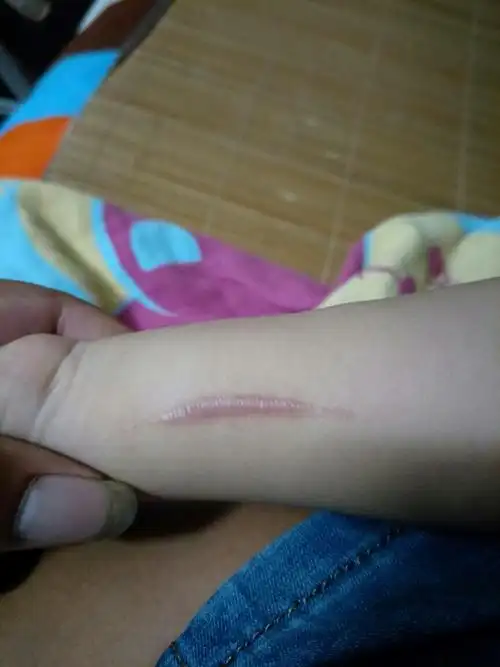 请问这到伤疤能修复吗,刀割的