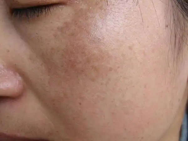 面部患黄褐斑怎么办好