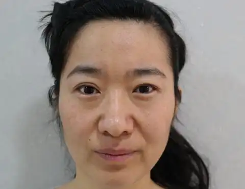 面部皮肤松弛怎么办,今年32岁,下垂严重有什么好的解决办法吗?