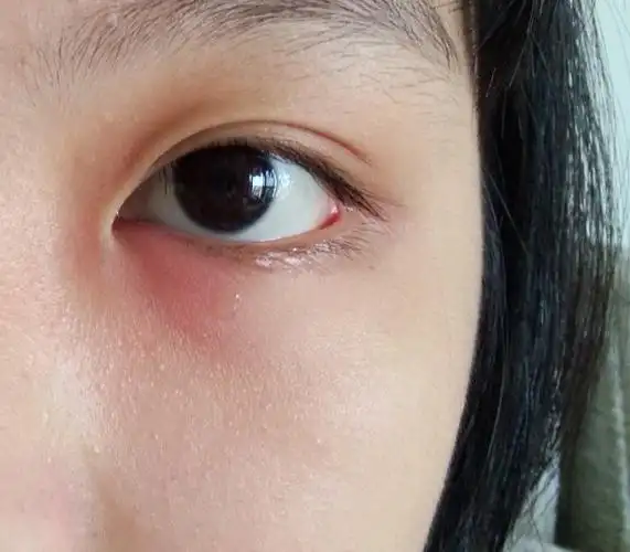 眼角窝又肿又痛,是怎么回事?什么原因,怎么恢复?