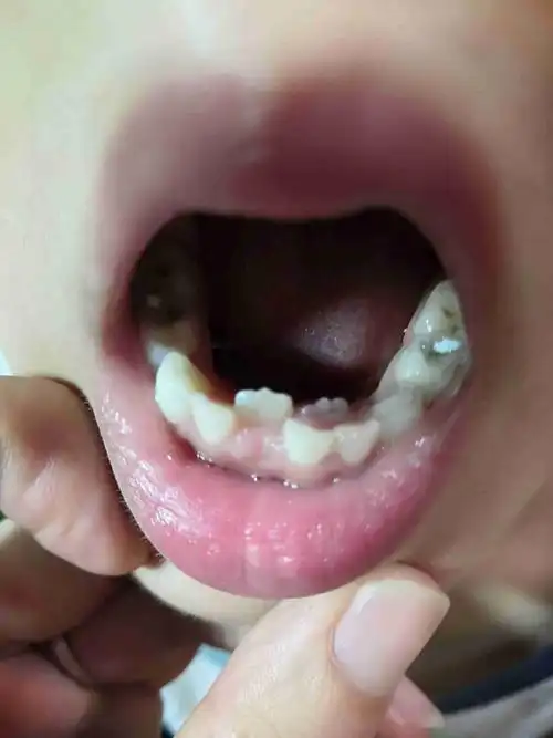 孩子7周岁,双排牙,怎么操作?