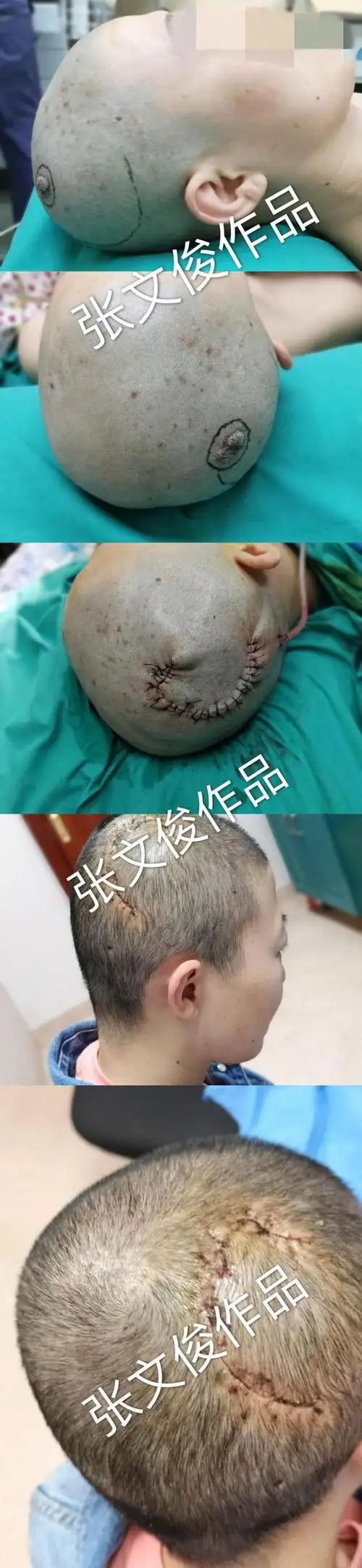 术后病理提示:外毛根鞘瘤手术方式:扩大切除,头皮旋转瓣转移修复,完美