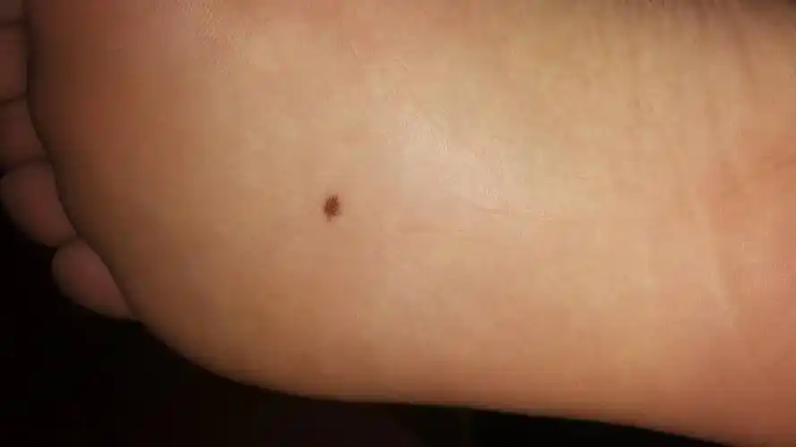我脚底有一颗黑色的圆点是什么