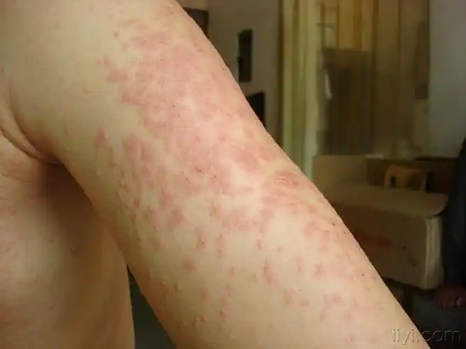 看图诊断马拉色菌毛囊炎