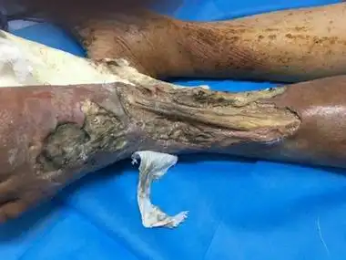 临床上可表现为脚踝处皮肤大面积坏死,露出脚踝部位骨头,周围及脚背