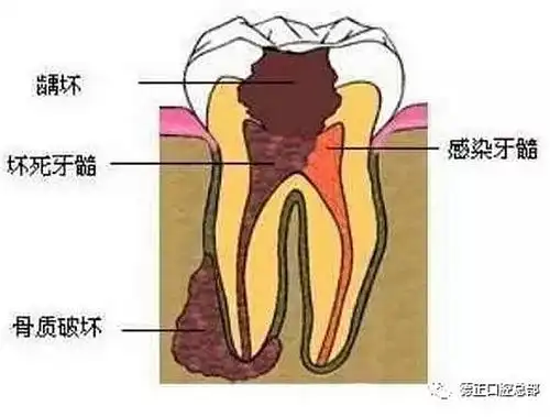 什么是牙齿根管治疗 哪些牙齿需要做根管治疗 科贸嘉友收录