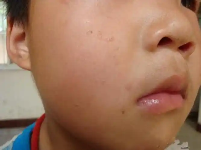 扁平疣图片_扁平疣症状表现图片大全_有来医生