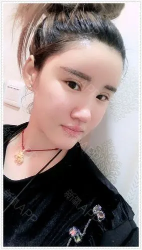 自体脂肪填充全脸,术后一个月脂肪移植效果,是不是很_圈子-新氧美容