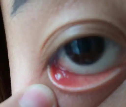 眼睛里长了个白色的东西如图,谁知道是什么?有点像口腔溃疡