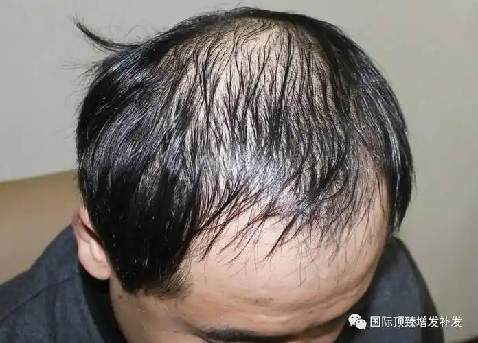 脂溢性脱发秃顶如何自救!