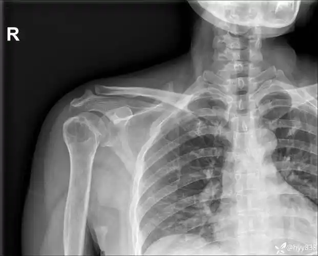 中年女性,发现右肩关节占位2天.有特征,有细节---(有结果)
