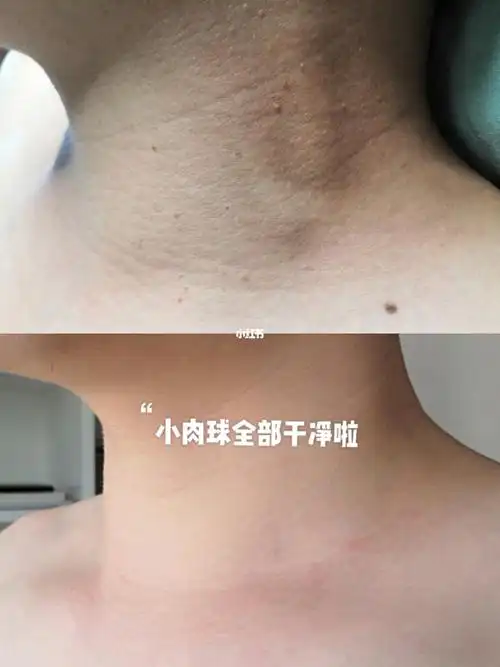 满脖子扁平疣提取半个月的效果,看过去真的是干净舒服很多哦