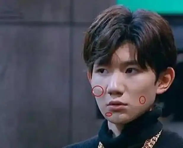 王源长痘痘王源的痘痘多到不加滤镜都没眼看了