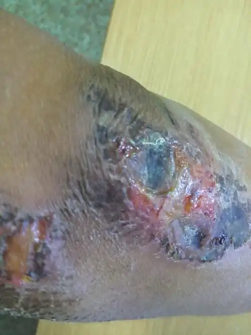 胳膊大面积擦伤后感染,好像是痂下化脓,而且伤口下面整个小臂肿胀.