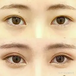 埋线和全切的区别图片