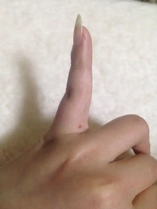 小指缝有一颗痣是代表什么?有图