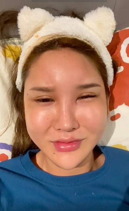 女网红额头填充成"天鹅头"形状,自称变成畸形,一脸生不如死