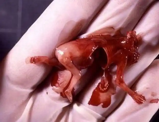 怀孕十几天流产图片_有来医生