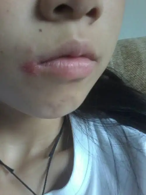 嘴角长的疮,不知道是什么长了一年多了,强迫症总喜欢撕疮上的皮,然后