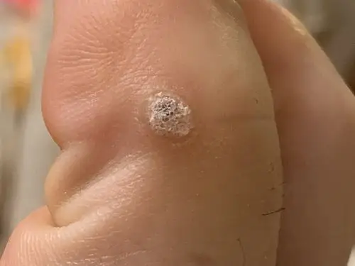 请问脚上长了这个怎么去除