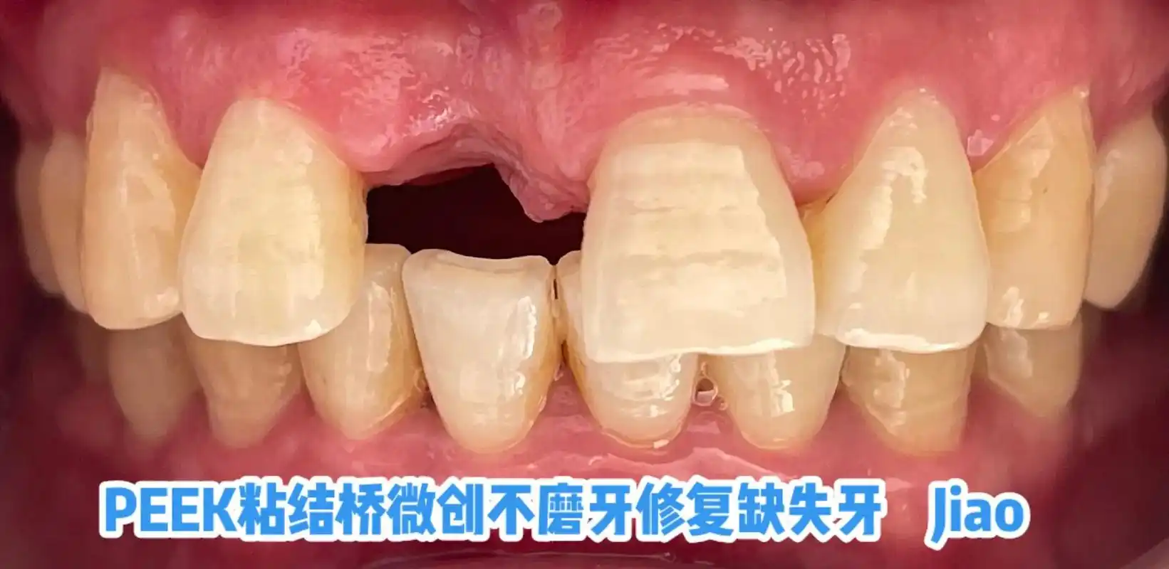 peek粘结桥微创修复#牙齿07 #一口好牙 #专业的事交给 - 抖音