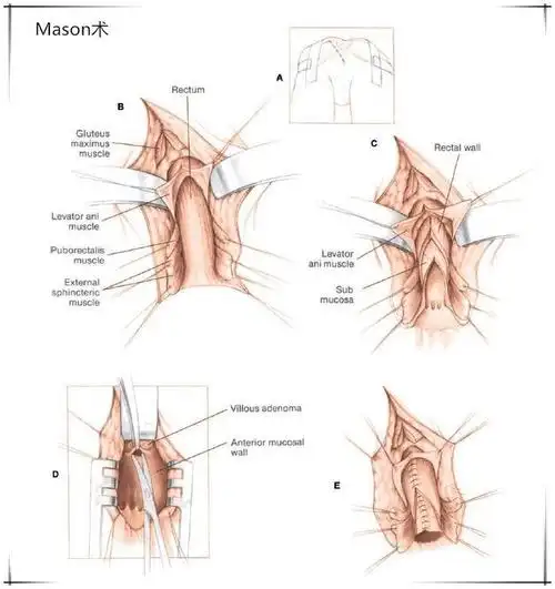 直肠癌手术历史回顾