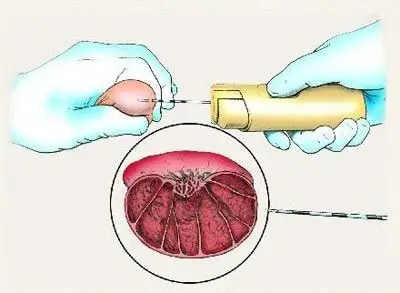 通过睾丸穿刺获取精子做试管婴儿 - 试管婴儿医院,北京不孕不育医院