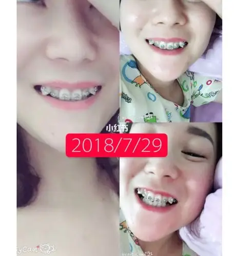 虎牙矫正,刚把下牙套带上,还不知道需要多久摘牙套